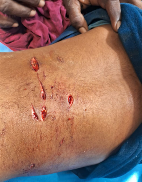 You are currently viewing 6 ਸਾਲਾ ਬੱਚੇ ਨੂੰ ਅਵਾਰਾ ਕੁੱਤਿਆਂ ਨੇ ਕੀਤਾ ਗੰਭੀਰ ਜਖਮੀ,ਹਸਪਤਾਲ ਚ ਬੱਚਾ….